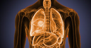 Atualiza25 | Oncologia - Neoplasias do tubo digestivo - Além do cólon e reto